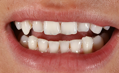 Fig. 1: Situación de partida insatisfactoria en la zona de los dientes anteriores.