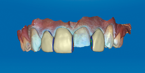 Fig. 2: Three veneers that have already been constructed; the original tooth is still visible in region 11.