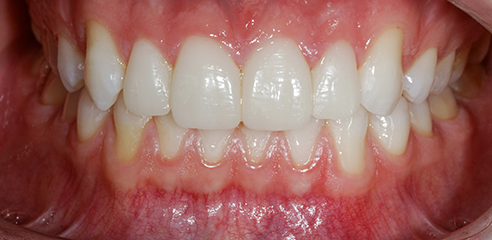 Fig. 3: Risultato finale nella bocca del paziente.