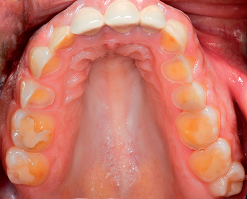 Fig. 1a: Situación de partida: dentadura erosionada de un paciente.
