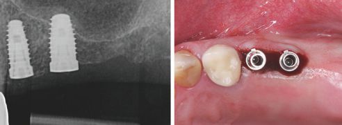 Fig. 2: X-ray image of both implants after three months of healing.
Fig. 3: Screwed scan posts on the exposed implants.