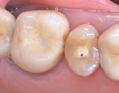 Fig. 1a: Restauraciones necesitadas de renovación en los dientes 25 y 26.