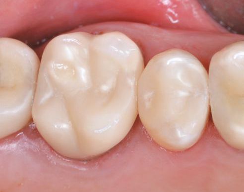 Ill. 1b : Situation après la pose en bouche d'une couronne et d'un onlay en céramique hybride.

Source : cabinet dentaire Dr Michael Maier