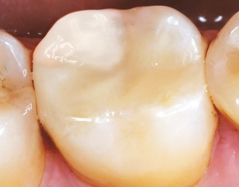 Ill. 2b : La restauration en VITA ENAMIC posée en bouche.

Source : cabinet dentaire Dr Dirk Ostermann