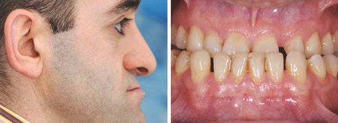 Ill. 2 : L'examen extra oral montre que le tiers inférieur du visage est réduit.
Ill. 3 : Examen en bouche : situation en intercuspidation maximale.