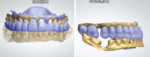 Fig. 8: Superimposition of the data sets of digital molding with and without splints in.
Fig. 9: Virtual design of the individual tooth restorations using superimposed scans.