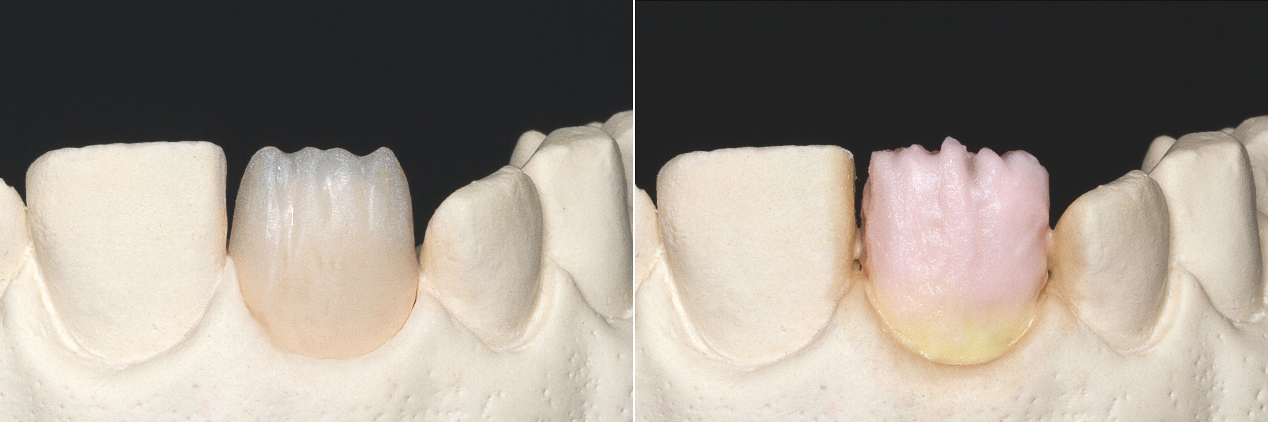 Fig. 1: Incisally reduced crowns.
Fig. 2: Completion of the tooth shape: in the cervical region with VITA VM 11 SUN DENTINE and in the body with VITA VM 11 TRANSPA DENTINE in the correct tooth shade.