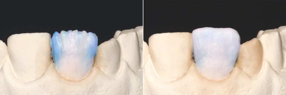 Fig. 5: Mesial, distal and discreetly between the mamelons, a mixture of EO2 and WIN was applied.
Fig. 6: Completion of the overall shape of the restoration with a mixture of EO1 & WIN.
