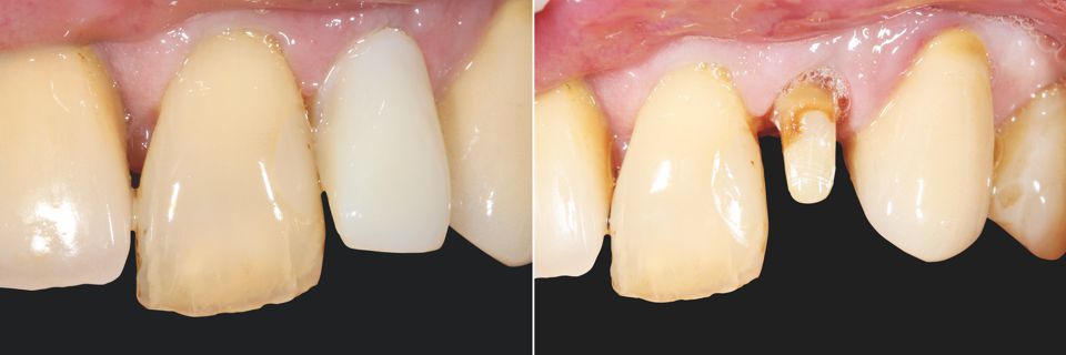 Fig. 1: Initial situation of provisional restoration of tooth 22.
Fig. 2: Exposed and built-up tooth stump.