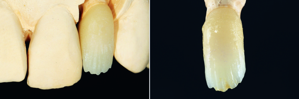 Fig. 3: The CAD/CAM-manufactured and manually reduced crown framework made of VITABLOCS RealLife.
Fig. 4: Cut-back framework characterized with VITA INTERNO (incisal Int03/cervical Int04).