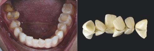 Fig. 2: También requerían saneamiento las zonas de los dientes posteriores en los maxilares superior e inferior.
Fig. 3: Para las regiones 13 hasta la 23 se confeccionaron coronas individuales de cerámica vítrea prensada.
