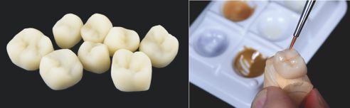 Fig. 4: Todas las coronas de los dientes posteriores (en la imagen: maxilar superior) se confeccionaron a partir de VITA ENAMIC.
Fig. 5: Para la caracterización de las superficies se utilizaron VITA ENAMIC STAINS en combinación con materiales de recubrimiento VITA VM LC flow.