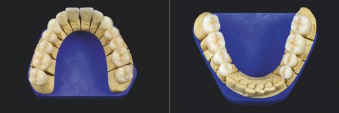 Fig. 8: Las restauraciones para el maxilar superior, sobre el modelo.
Fig. 9: Las restauraciones para el maxilar inferior, sobre el modelo.