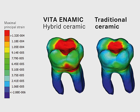 Fig. 3: Virtual tooth model made of VITA ENAMIC and ceramic.