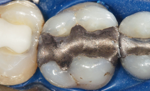 Fig. 1: Situazione iniziale: il dente 26 è riabilitato con un'otturazione di amalgama insoddisfacente.