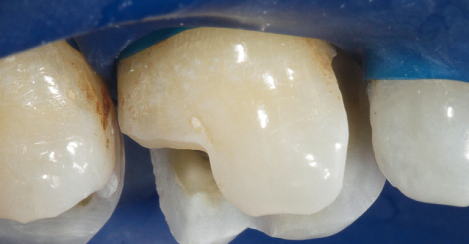 Fig. 3: Preparazione: se non vi è sufficiente sostegno da parte della dentina, si consiglia una riduzione delle cuspidi.