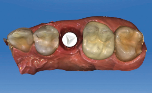 Abb. 5: Die Implantatposition wurde mit dem 3D-Scanner CEREC Omnicam erfasst.