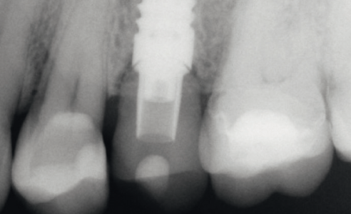 Fig. 9: La radiografia mostra una situazione ossea ed un adattamento ottimali.