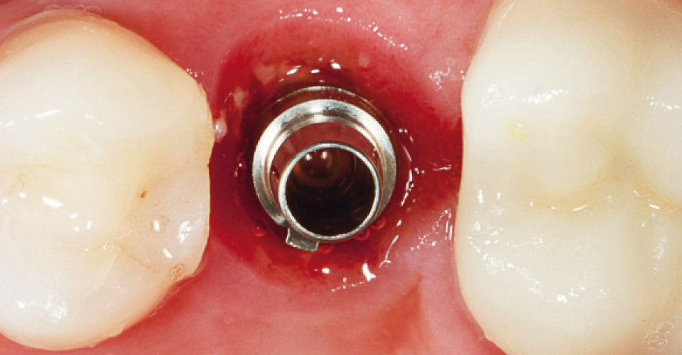 Fig. 3: Se atornilló un poste de escaneo en el implante.
