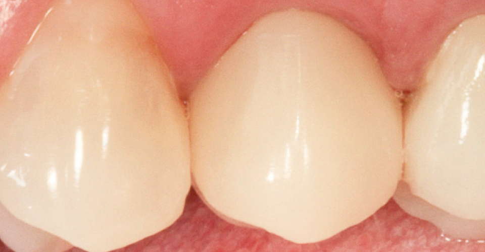 Fig. 8: El resultado final muestra una integración armoniosa de la corona de cerámica híbrida sobre pilar en el tejido blando y con respecto a los dientes adyacentes.