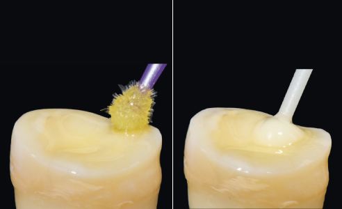 Ill. 6a :  Le liant assure une liaison adhésive sûre avec la dent.
Ill. 6b : Le composite de scellement fluide est appliqué sur la préparation.