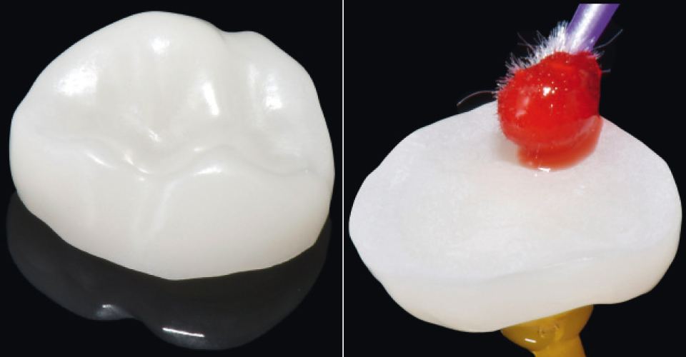 Fig. 2a: Corona ceramica parziale in VITA ENAMIC realizzata con tecnologia CAD/CAM.
Fig. 2b: Sul lato del lumen la ceramica ibrida viene mordenzata per 60 sec. con acido fluoridrico.