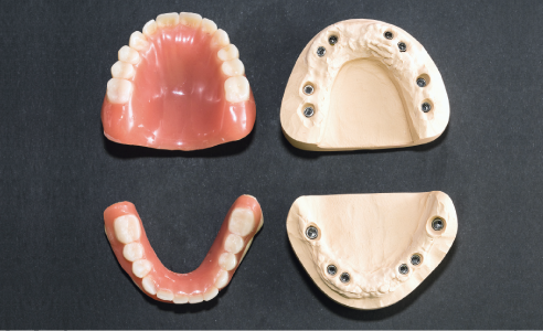 Fig. 1: Master models with implant posts and immediate prostheses.