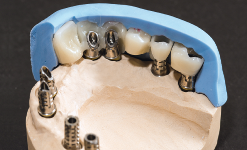 Fig. 4: An implant-supported provisional restoration  was fabricated using the silicone matrix.