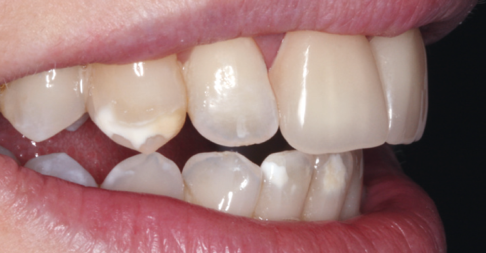 Fig. 6: Las coronas de VITA ENAMIC multiColor presentan un aspecto natural in situ. Tras el resultado positivo, la paciente quiso recibir tratamiento en los demás dientes.