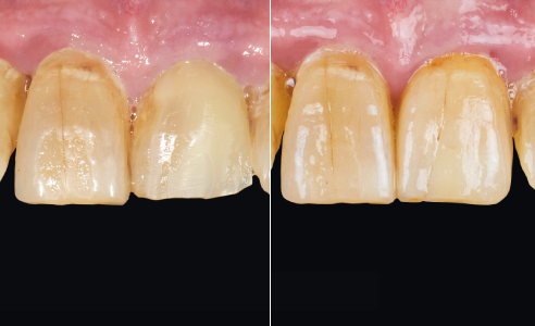Abb. 1: AUSGANGSSITUATION: Kompositaufbau an 21 nach distaler Querfraktur der Zahnkrone.
ERGEBNIS: Der Patient zeigt sich mit dem finalen ästhetischen Ergebnis sehr zufrieden.