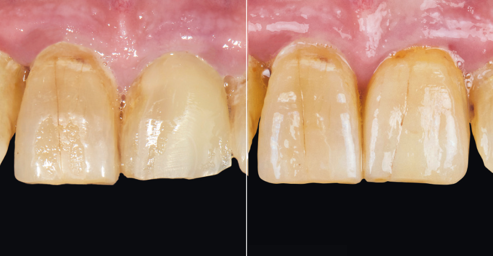 Fig. 1: SITUACIÓN DE PARTIDA: reconstrucción con composite en el diente 21 tras una fractura transversal distal de la corona dental.
RESULTADO: el paciente se muestra muy satisfecho con el resultado estético final.