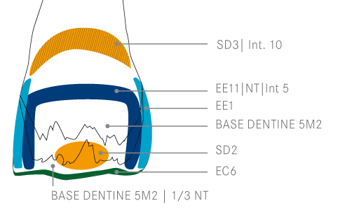 Ill. 3 : Après la détermination de la couleur de base 5M2 avec le VITA Toothguide 3D-MASTER, le schéma de stratification a été esquissé.