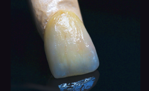 Fig. 6: I colori VITA INTERNO consentono una riproduzione dei denti naturali ricca di sfaccettature e tipica per l'età.