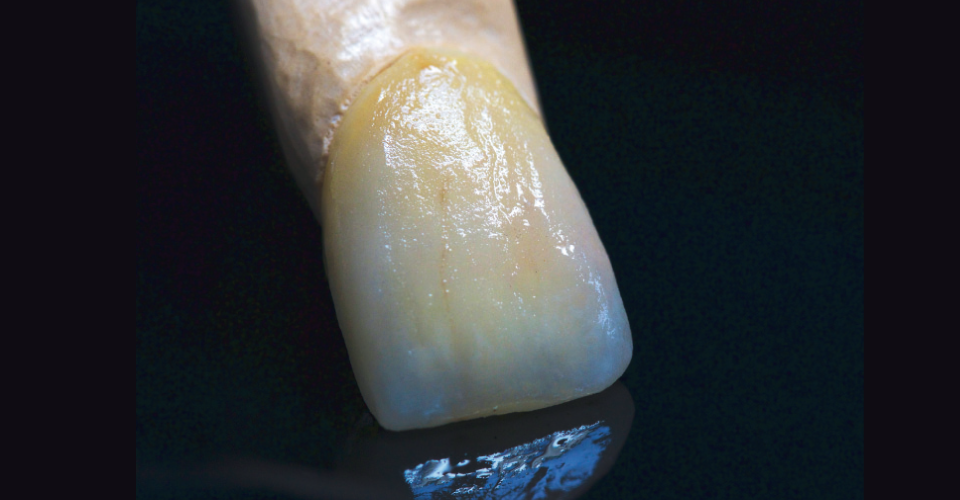 Fig. 6: I colori VITA INTERNO consentono una riproduzione dei denti naturali ricca di sfaccettature e tipica per l'età.