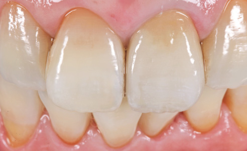 Fig. 15: RESULTADO: la restauración definitiva en el diente 21 armoniza perfectamente con los dientes adyacentes naturales y presenta un juego de colores y luces natural.