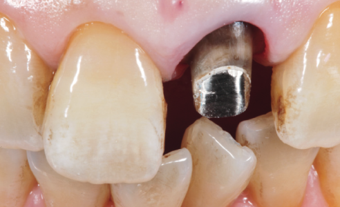 Abb. 2: Nach Entfernung der Krone zeigen sich verfärbtes Dentin und ein metallischer Aufbau.