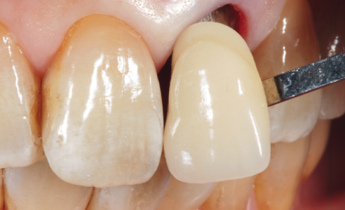 Abb. 3: Die Zahnfarbe wurde mittels VITA Linearguide 3D-MASTER ermittelt.