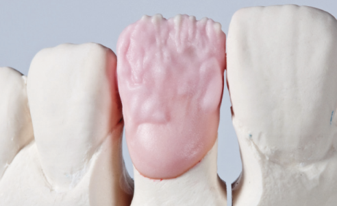 Ill. 7 : Le noyau de dentine a été créé et personnalisé avec VITA VM9 BASE DENTINE 3M2.