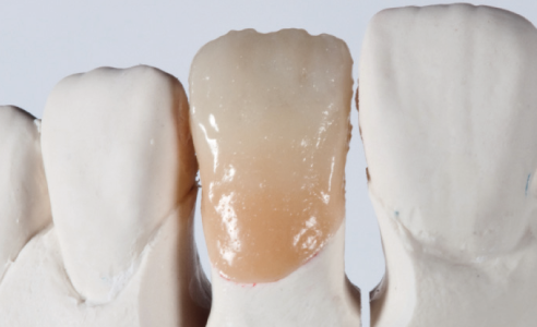 Fig. 8: Estado de la restauración tras la primera cocción de la dentina.