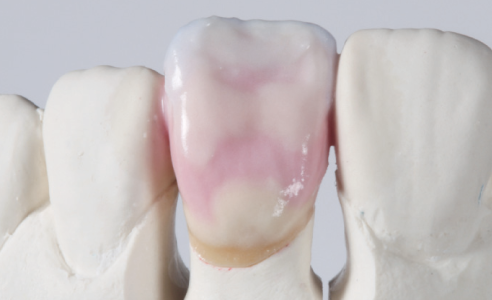 Ill. 9 : Stratification de 3M2 avec des effets individuels pour la deuxième cuisson de dentine.