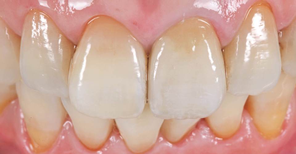 Ill. 15 : RÉSULTAT : la restauration définitive s'harmonise parfaitement sur la 21 avec les dents voisines naturelles et présente un jeu de couleur et de lumière naturel.