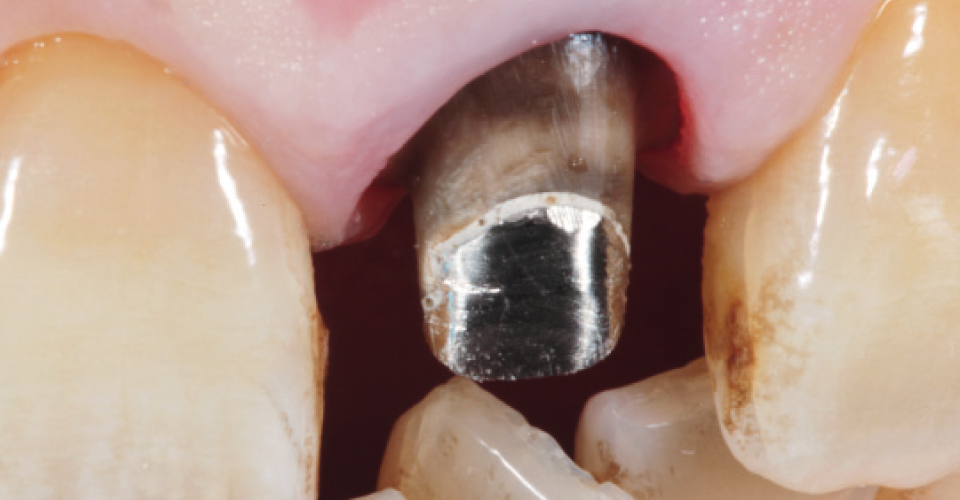 Abb. 2: Nach Entfernung der Krone zeigen sich verfärbtes Dentin und ein metallischer Aufbau.