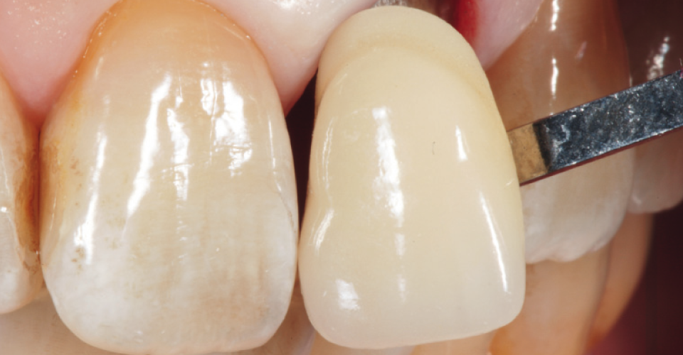 Abb. 3: Die Zahnfarbe wurde mittels VITA Linearguide 3D-MASTER ermittelt.