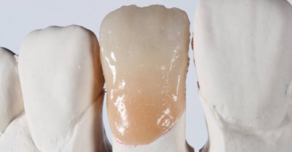 Fig. 8: Situazione del restauro dopo la prima cottura della dentina.