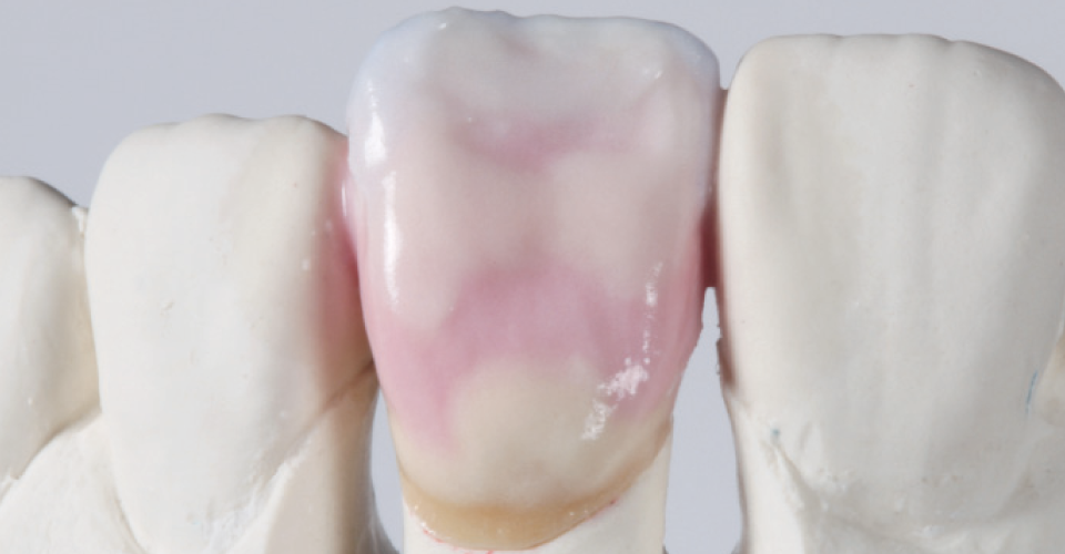 Fig. 9: Estratificación de 3M2 con efectos individuales para la segunda cocción de dentina.
