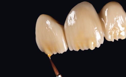 Fig. 4: Sul corpo dentinale ridotto con i supercolori e flow CHROMA PLUS si applicano mammelloni e si intensifica il bordo incisale.