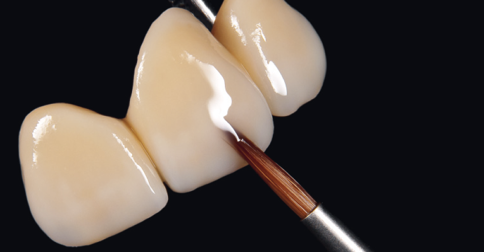 Fig. 6: Construcción de la forma final del diente mediante material de esmalte.