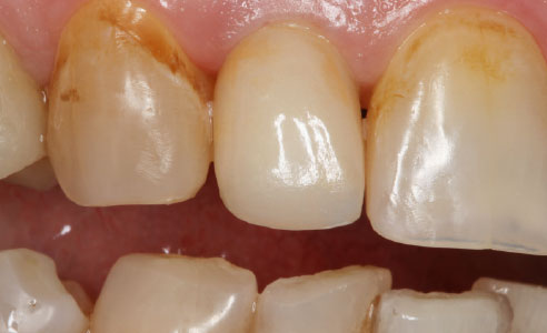 Fig. 12: Result: The treatment result with the highly esthetic, monolithic feldspar ceramic crown.