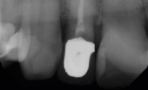 Abb. 1: Die Wurzel von Zahn 12 war aufgrund von Überlastung frakturiert.