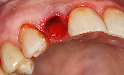 Fig. 2: The bony alveolus after the extraction of incisor 12.